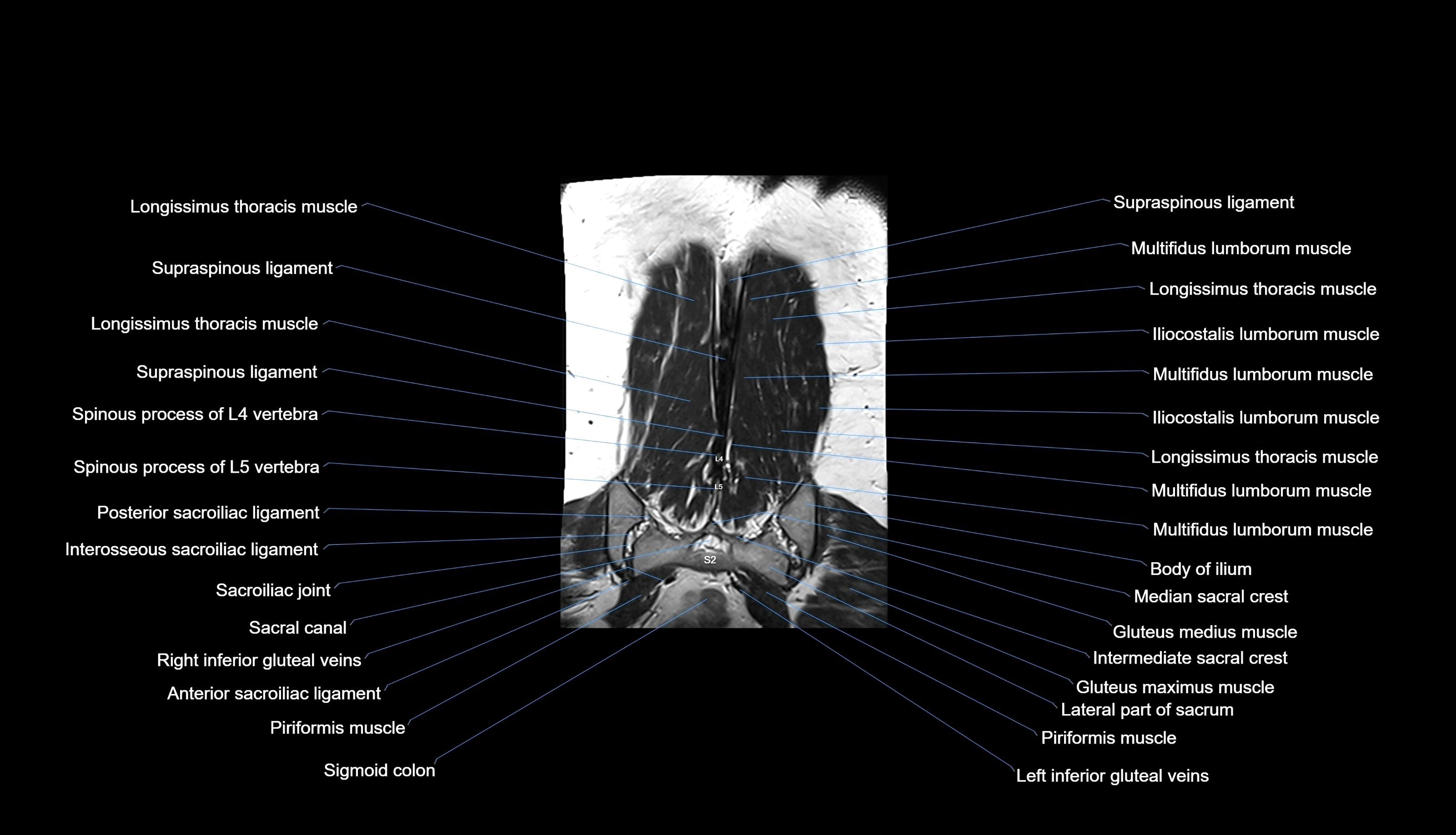 MRI lumbar spine labelled coronal cross sectional anatomy 3T radiology-img-00001-00034.webp